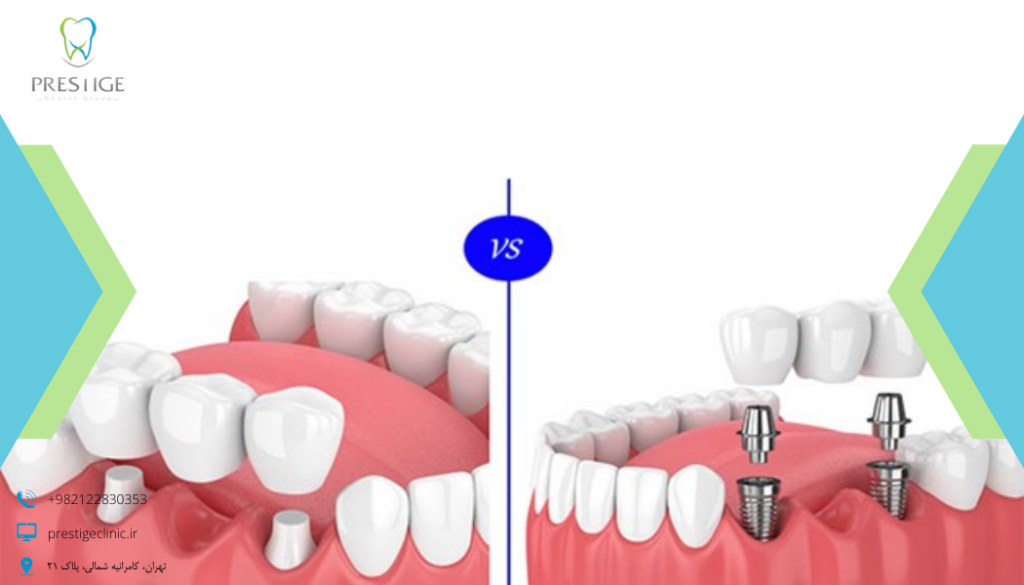 ایمپلنت دندان- کلینیک دندانپزشکی پرستیژ