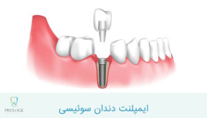 ایمپلنت دندان سوئیسی