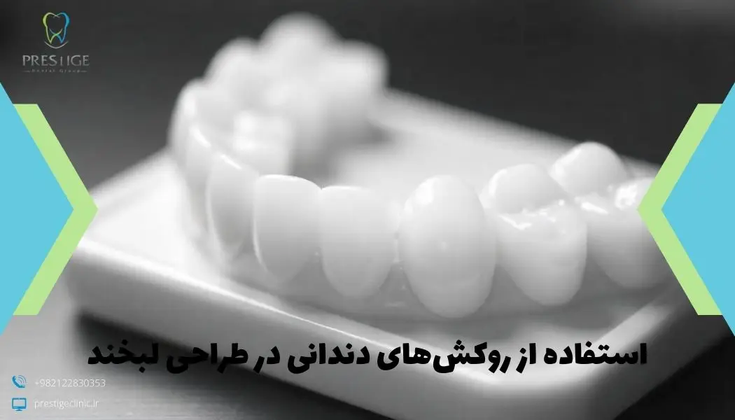 استفاده از روکش‌های دندانی در طراحی لبخند