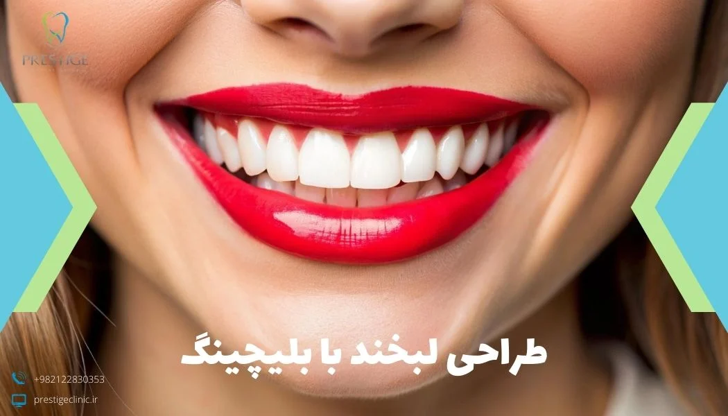 طراحی لبخند با بلیچینگ