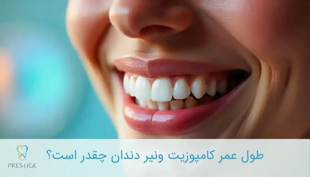 طول عمر کامپوزیت ونیر دندان