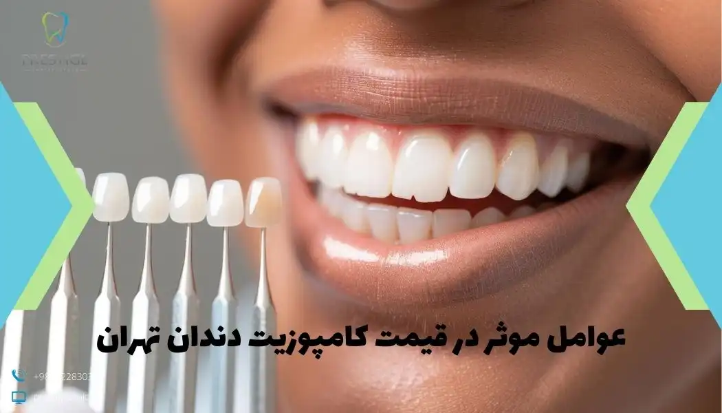 عوامل موثر در قیمت کامپوزیت دندان تهران