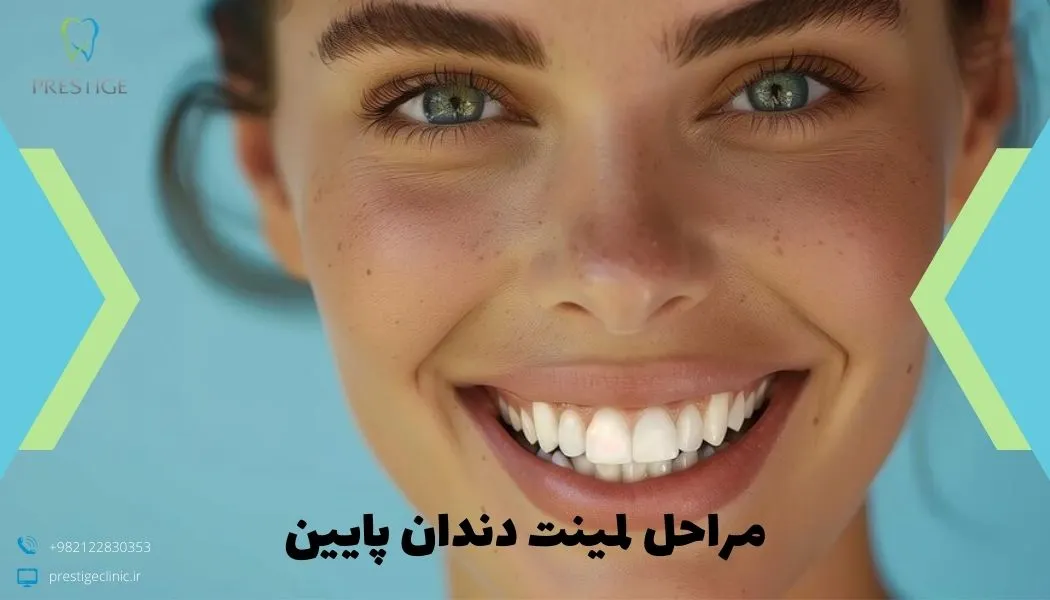 مراحل لمینت دندان پایین