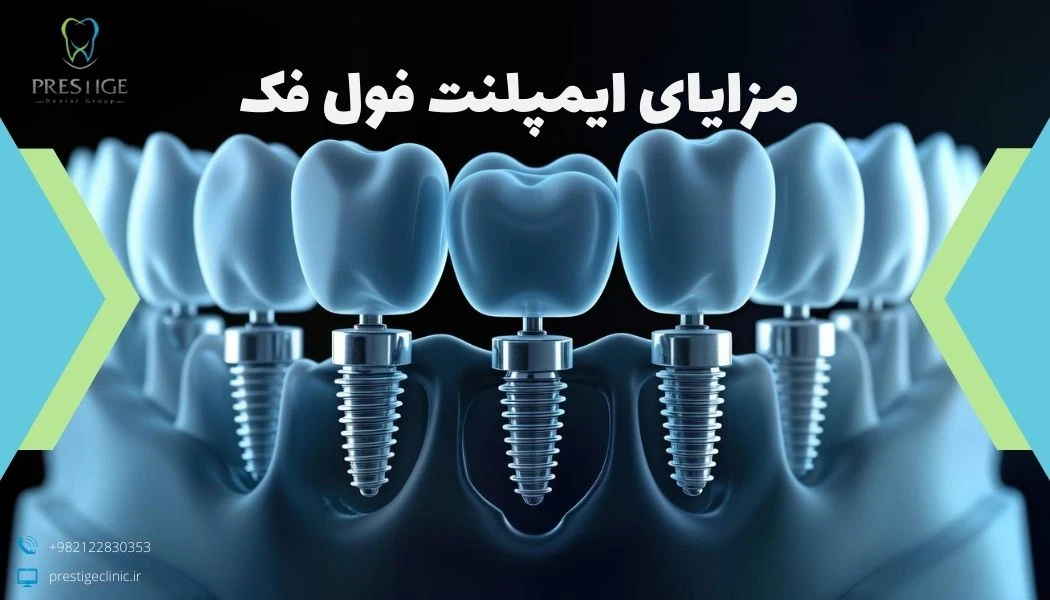 مزایای ایمپلنت فول فک