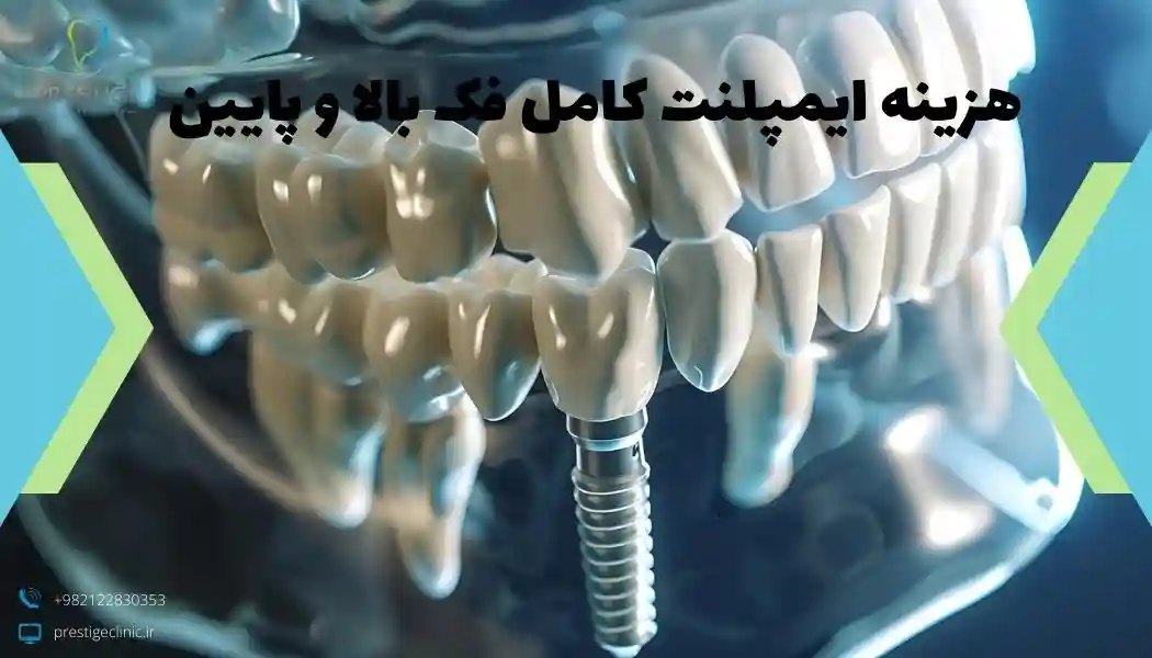 هزینه ایمپلنت کامل فک بالا و پایین