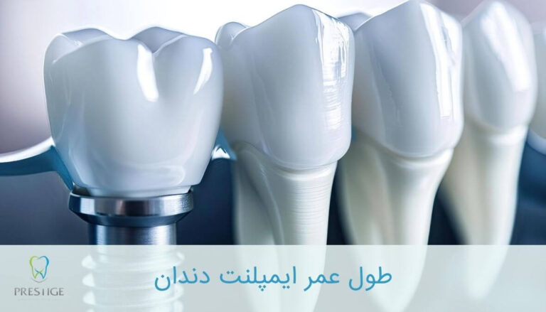 طول عمر ایمپلنت دندان