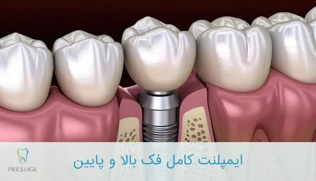 ایمپلنت کامل فک بالا و فک پایین