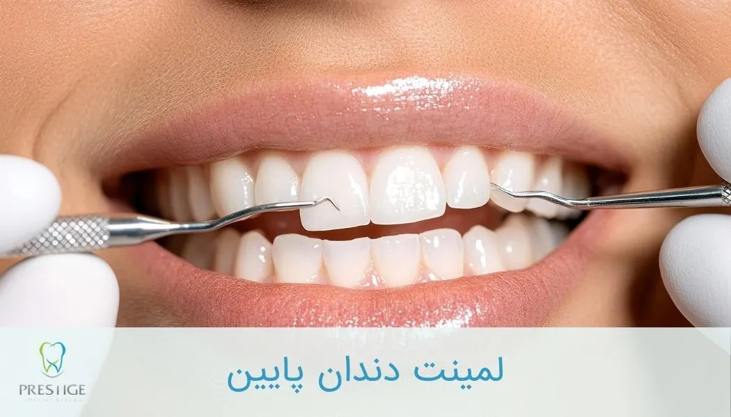 لمینت دندان پایین