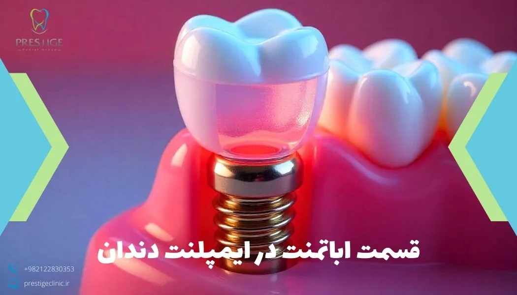 قسمت اباتمنت در ایمپلنت دندان