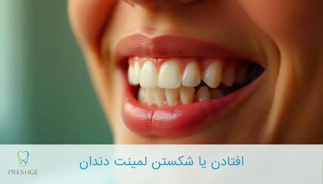 افتادن یا شکستن لمینت دندان