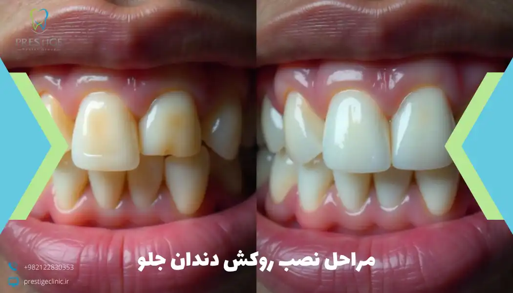 مراحل نصب روکش دندان جلو