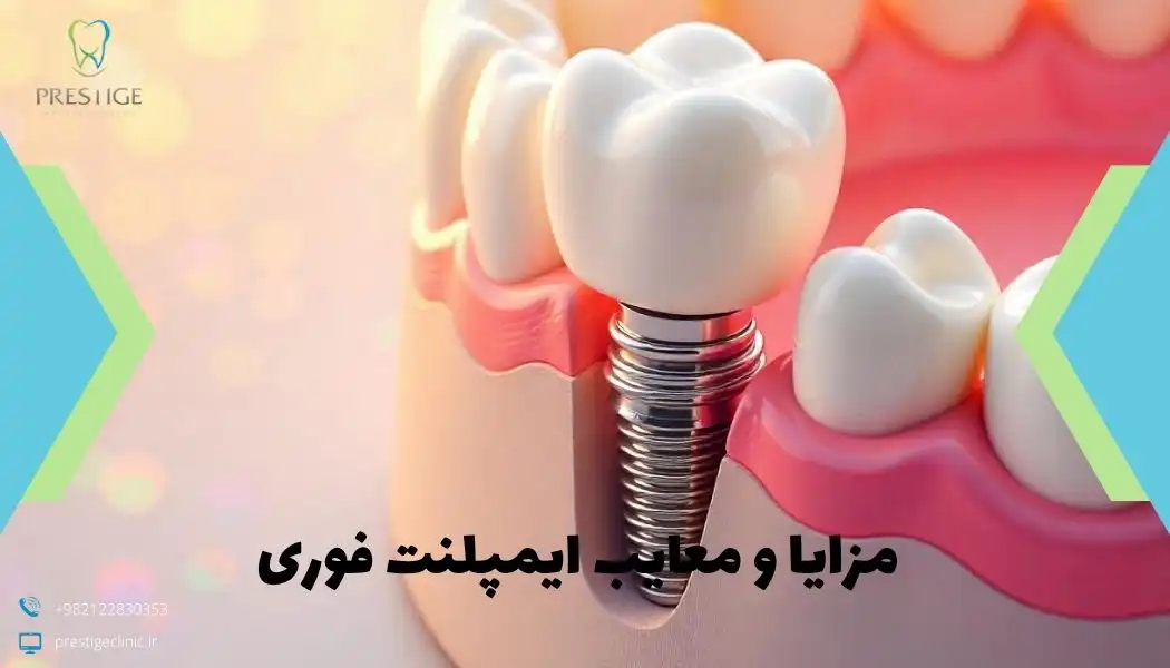 مزایا و معایب ایمپلنت فوری