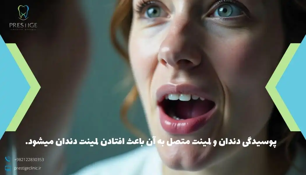 پوسیدگی دندان و لمینت متصل به آن