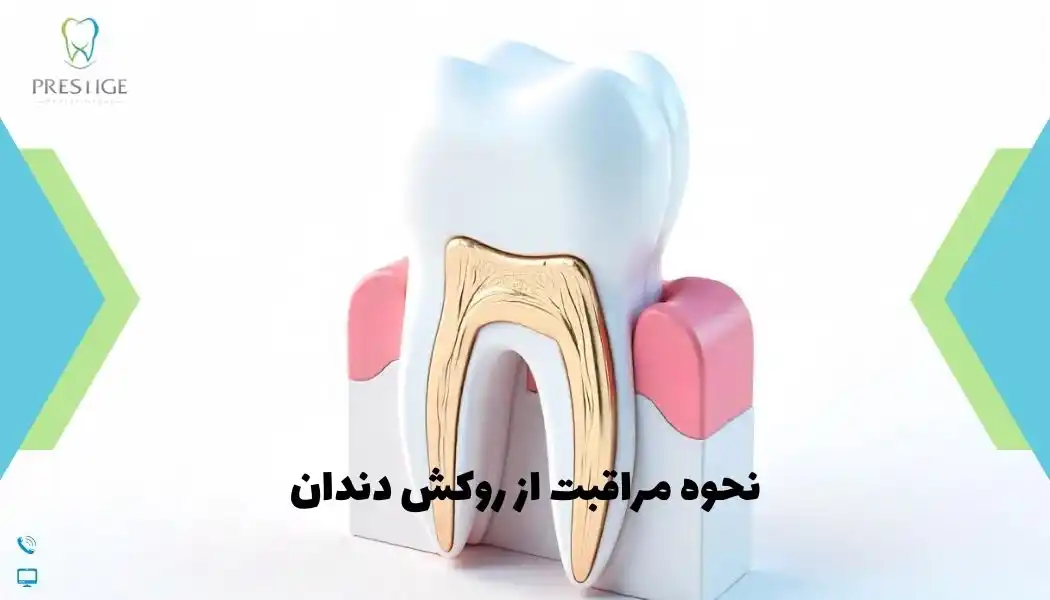 نحوه مراقبت از روکش دندان