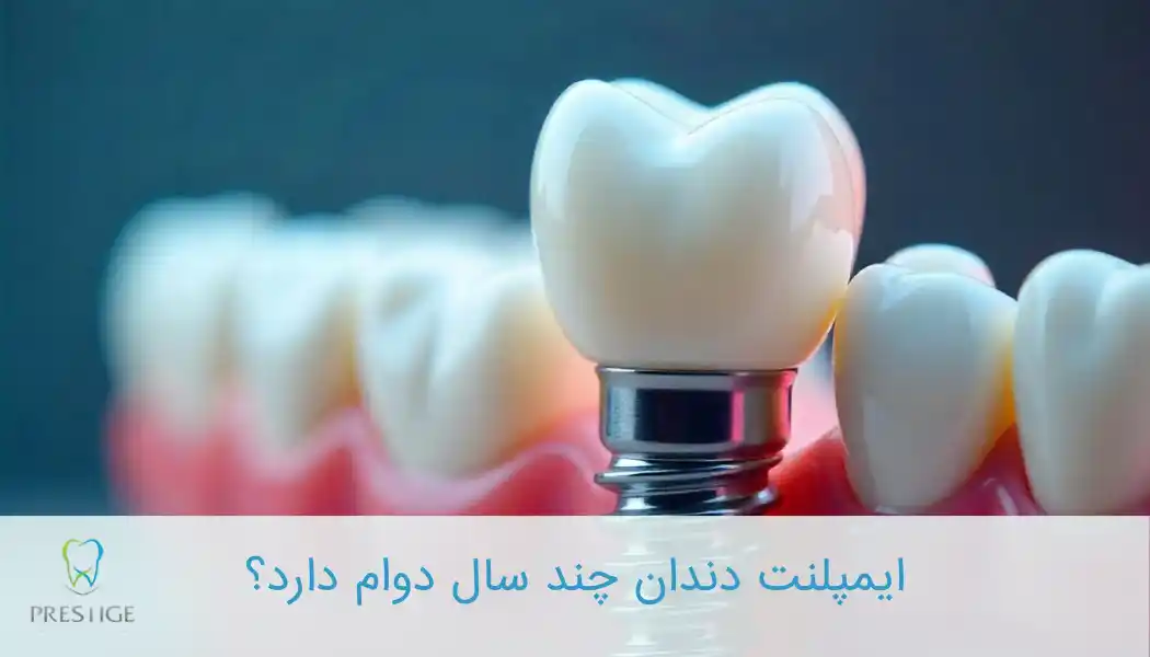 ایمپلنت دندان چند سال دوام دارد؟
